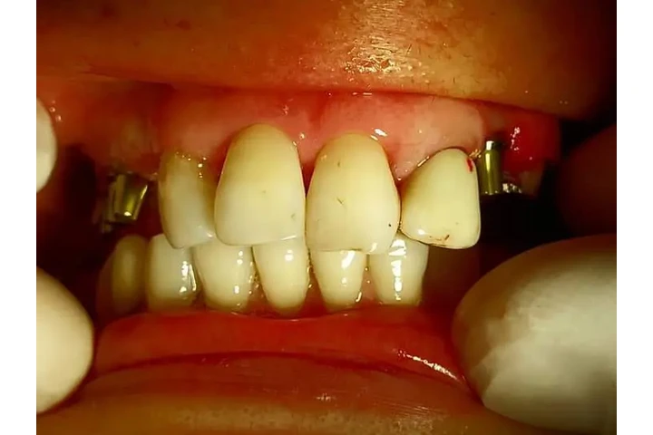 ODONTOLOGIA PRIVADA IMPLANTES image 2