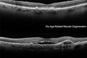 Macular degeneration doctors thumbnail