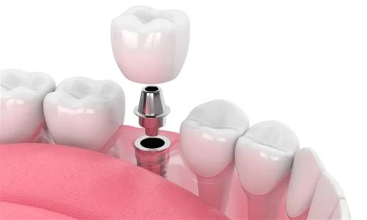 Implante dental en Escondido image 1