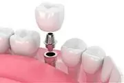 Implante dental en Escondido