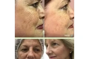 Lipo láser thumbnail