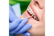 Implantes Dentales thumbnail