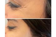 Rejuvenece tu rostro con botox thumbnail