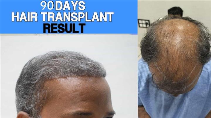 hair transplant image 4