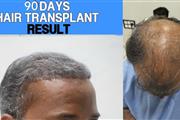hair transplant thumbnail