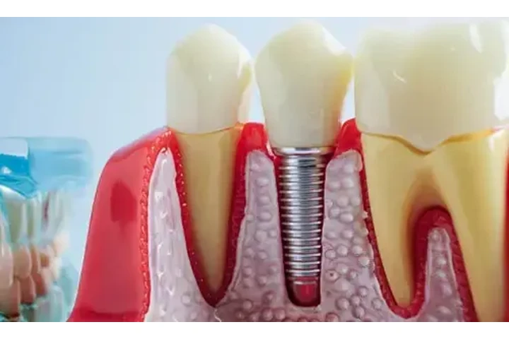 Rialto Dental Implant Studio image 4