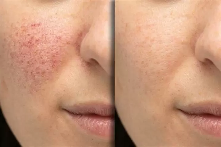 MICRONEEDLING NANO FACIAL image 2