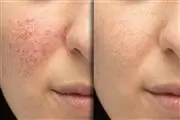 MICRONEEDLING NANO FACIAL thumbnail