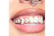 Blanqueo Dental 50$ thumbnail