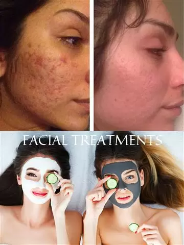 FACIAL ACNE LIMPIEZA PROFUNDA image 2