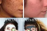 FACIAL ACNE LIMPIEZA PROFUNDA thumbnail