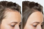 Scalp Micropigmentation en Seattle