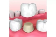 Implantes Dentales desde $799 thumbnail