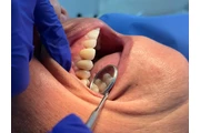 IMPLANTES DENTALES - CALI thumbnail