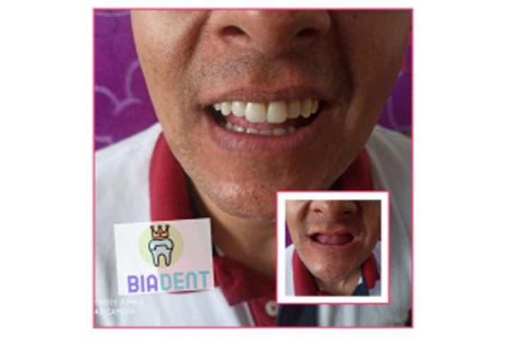 Prótesis dental a domicilio image 4