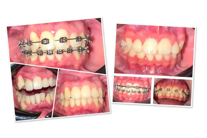 Implantes dentales desde $1999 image 3