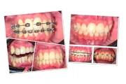 Implantes dentales desde $1999 thumbnail