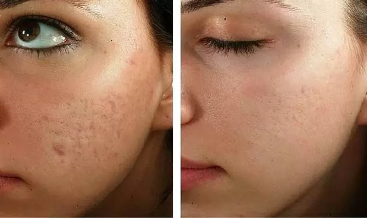 MICRONEEDLING NANO FACIAL image 1