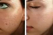 MICRONEEDLING NANO FACIAL en Los Angeles