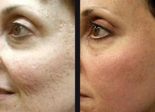 REJUVENE FACIAL MANCHAS  ACNE image 6