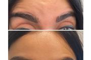 Rejuvenece tu rostro con botox thumbnail