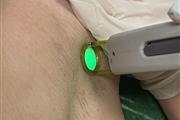 Laser Hair Removal in Miami thumbnail