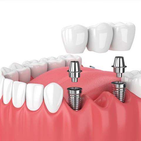 Bonita Smile Dental Center image 8