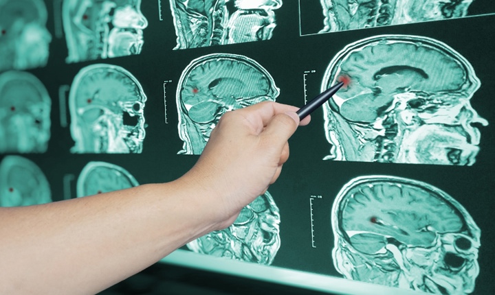 Consejos para prevenir un stroke