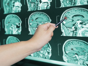 Consejos para prevenir un stroke