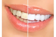 Dentista Cosmético en Los Angeles