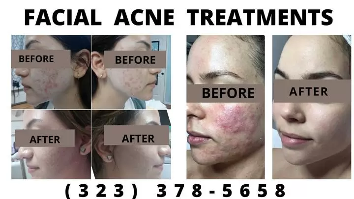 ACNE FACIAL LIMPIEZA PRODUNDA image 4