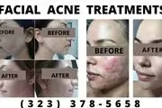 ACNE FACIAL LIMPIEZA PRODUNDA thumbnail