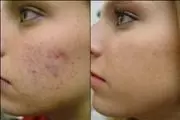 FACIAL ELIMINA CELULAS MUERTAS en Los Angeles