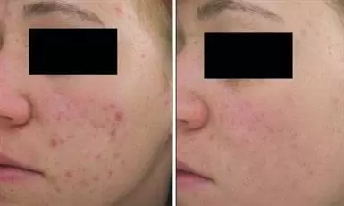 ACNE FACIAL LIMPIEZA PRODUNDA image 2