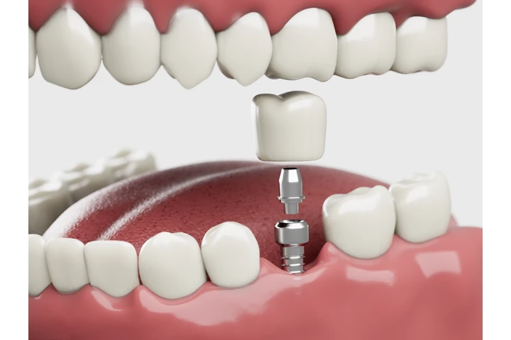 Best Dentist for Dental Implan image 1