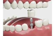 Best Dentist for Dental Implan en Denver