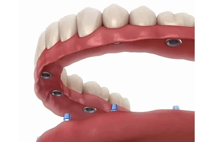 Whole Mouth Dental Implants image 1