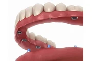 Whole Mouth Dental Implants en Denver
