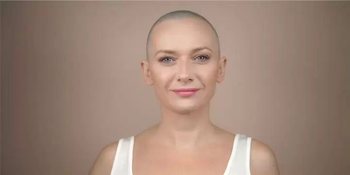 Pérdida de Cabello por Quimo image 1