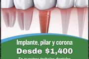 Implantes Dentales en Orange County