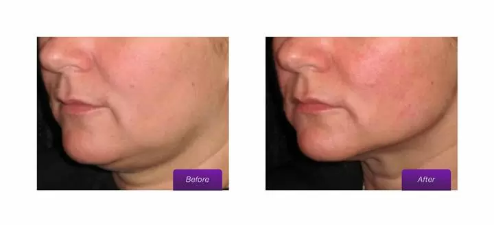 ULTRASONIDO FACIAL REJUVENECE image 4