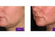 ULTRASONIDO FACIAL REJUVENECE thumbnail