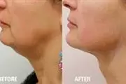 ULTRASONIDO FACIAL REJUVENECE thumbnail