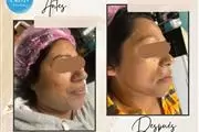 REJUVENE FACIAL MANCHAS  ACNE thumbnail