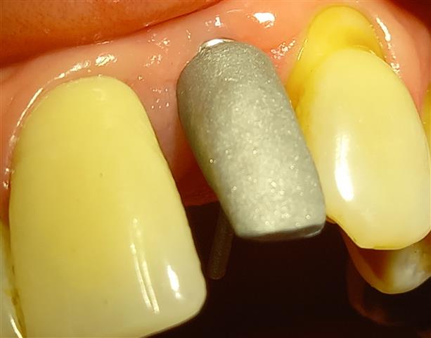 IMPLANTES DENTALES NACIONALES image 3