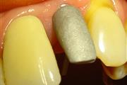 IMPLANTES DENTALES NACIONALES thumbnail