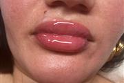 Relleno de labios y voltereta thumbnail