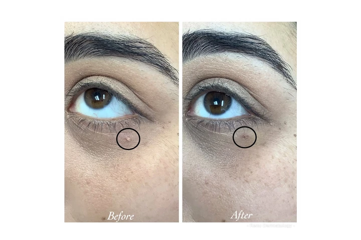¿Tienes verrugas irritados? image 1