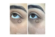 ¿Tienes verrugas irritados? en Orange County