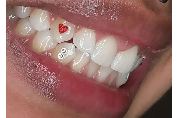 Blanqueamiento Dental $50 dls image 10